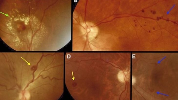 Coronavírus pode causar sérias lesões nos olhos, mostra estudo brasileiro
