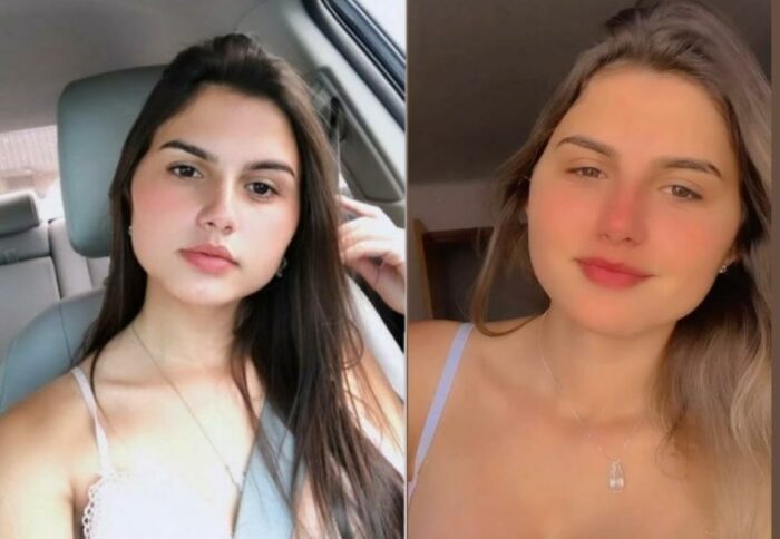 Depois da cirurgia: gêmeas trans contam experiência após redesignação sexual aos 19 anos