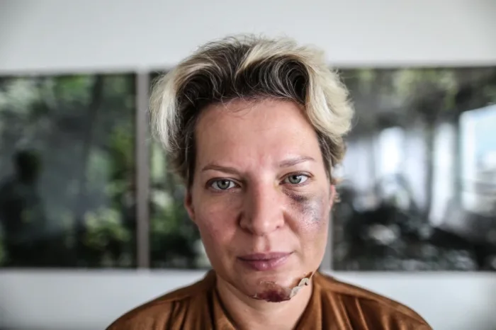 Polícia Civil conclui que Joice Hasselmann sofreu ‘queda da própria altura’