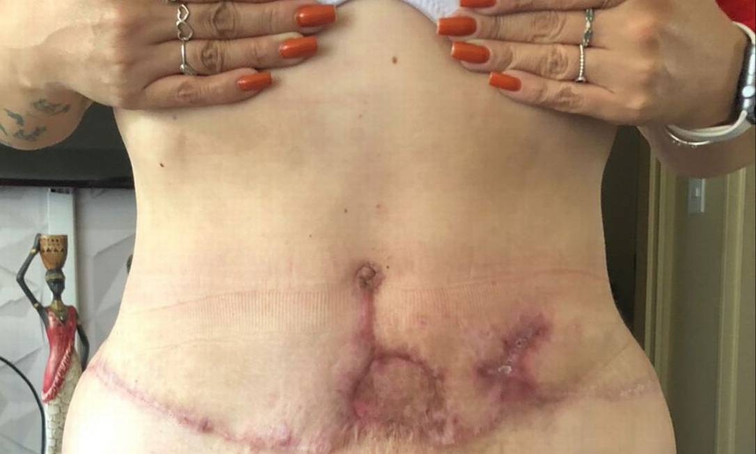 Mulheres denunciam cirurgiã plástica do DF por negligência e erro médico