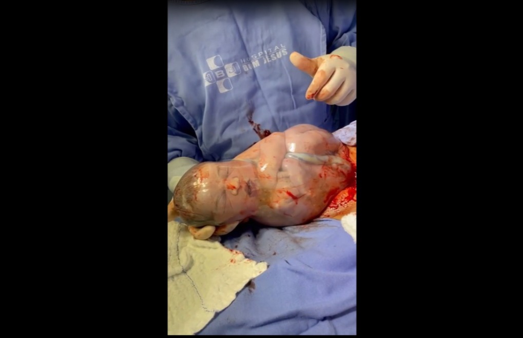Imagem emocionante: bebê nasce empelicado em Rondônia e vídeo viraliza