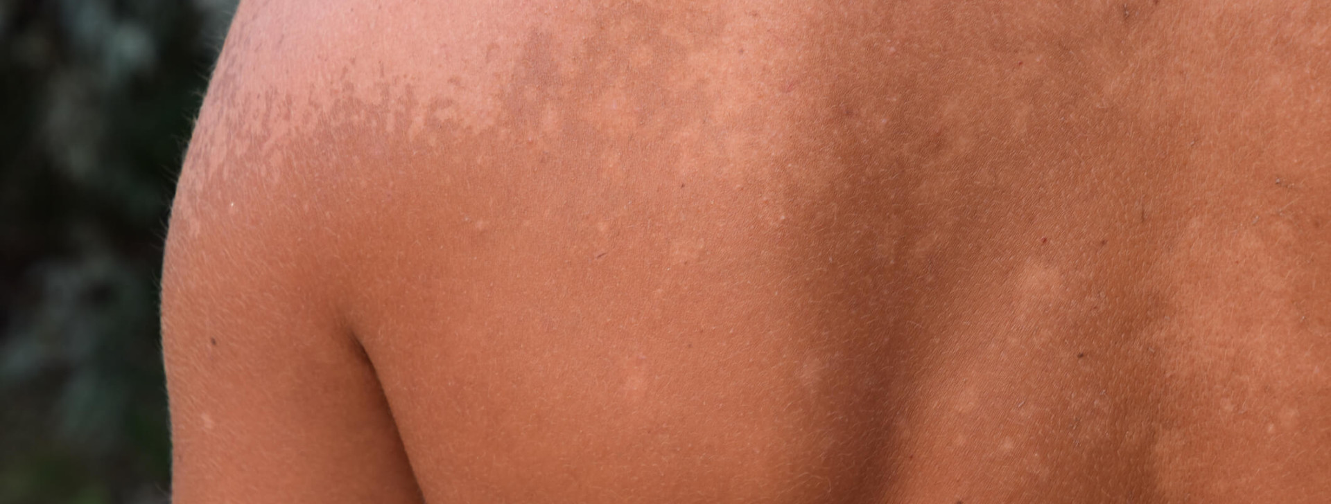 Lei que reajusta pensão de hansenianos é sancionada pelo governador do AM