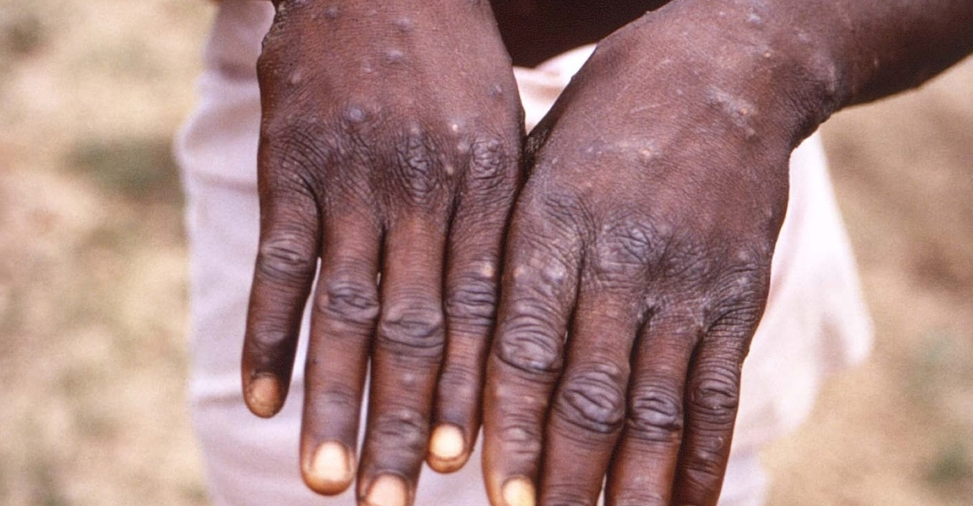 OMS reporta 780 casos de varíola do macaco em 27 países, mas diz que risco global é moderado