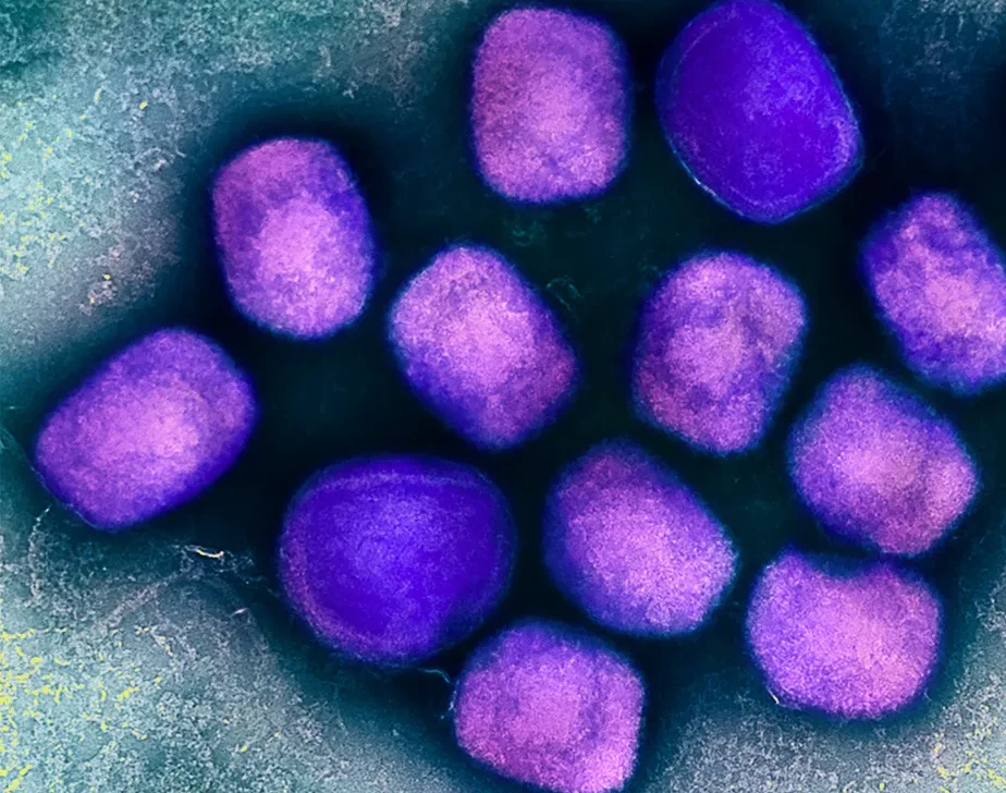 Paciente brasileiro diagnosticado com varíola dos macacos na Alemanha tem alta