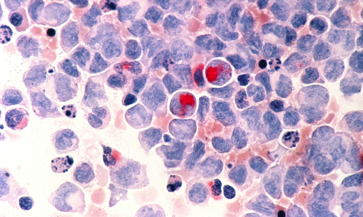 Programa de terapia celular para tratamento de câncer é lançado em São Paulo 