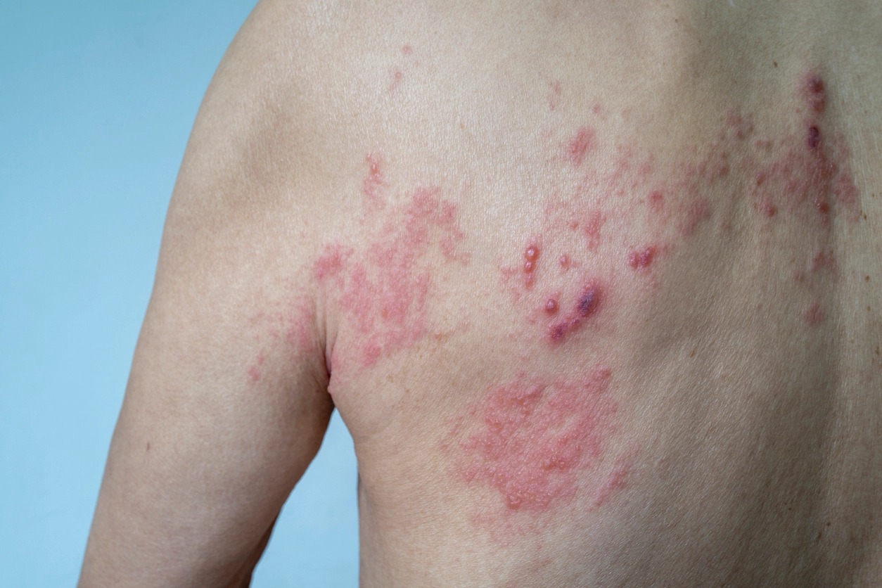 Herpes-zóster teve aumento de 35% na pandemia de Covid-19, mostra estudo; vacina está disponível no Brasil