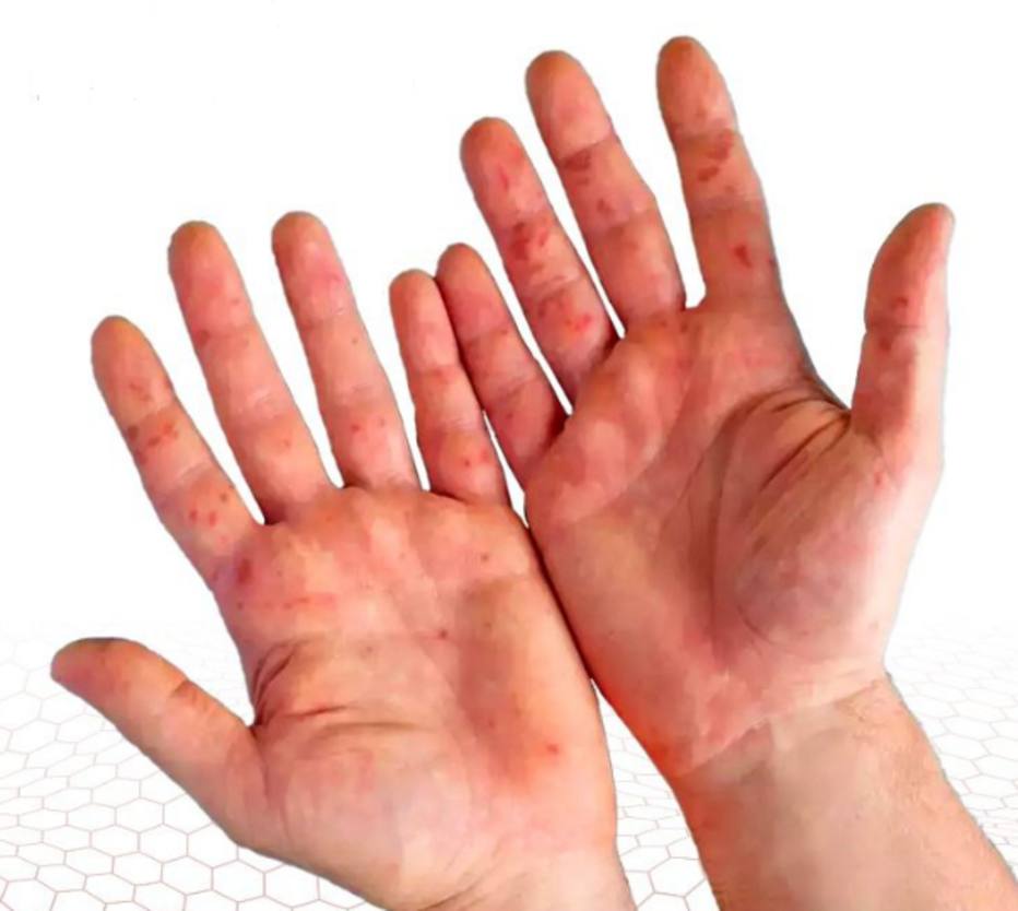 ‘Gripe do tomate’: veja quais os sintomas do vírus que se espalha na Índia