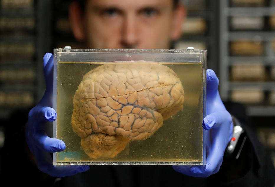 Estudo identifica região do cérebro onde ocorre as primeiras alterações causadas pelo Alzheimer