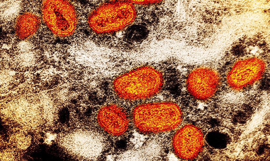 Estudos afirmam que varíola dos macacos pode ter transmissão assintomática