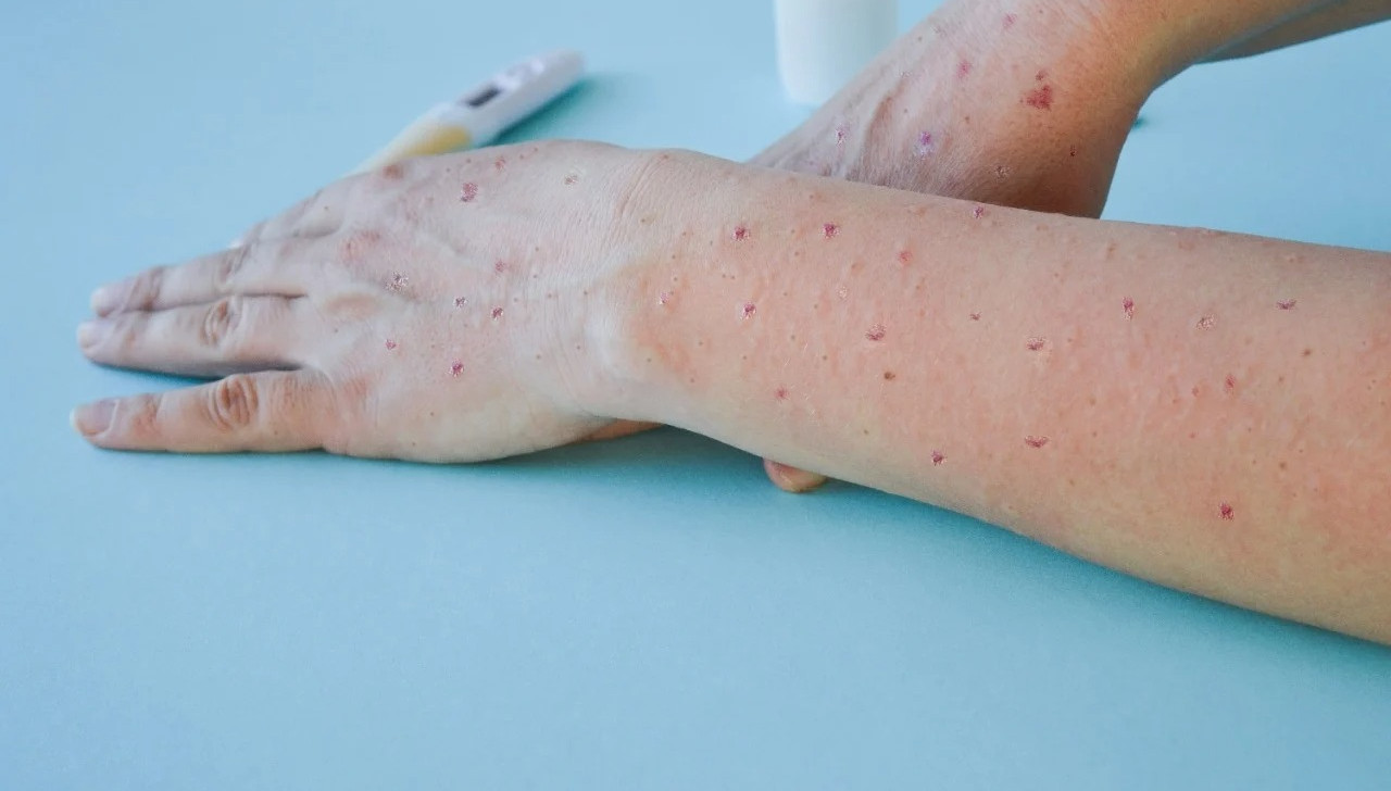 Monkeypox: AM confirma terceiro caso de varíola dos macacos; outros dois suspeitos seguem em vigilância