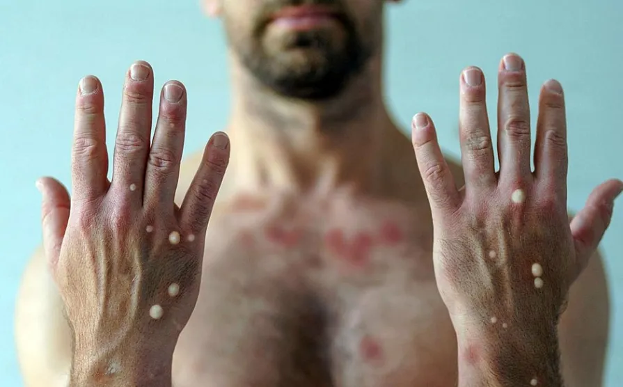 OMS analisa dados e pode decretar novo estado de emergência para mpox