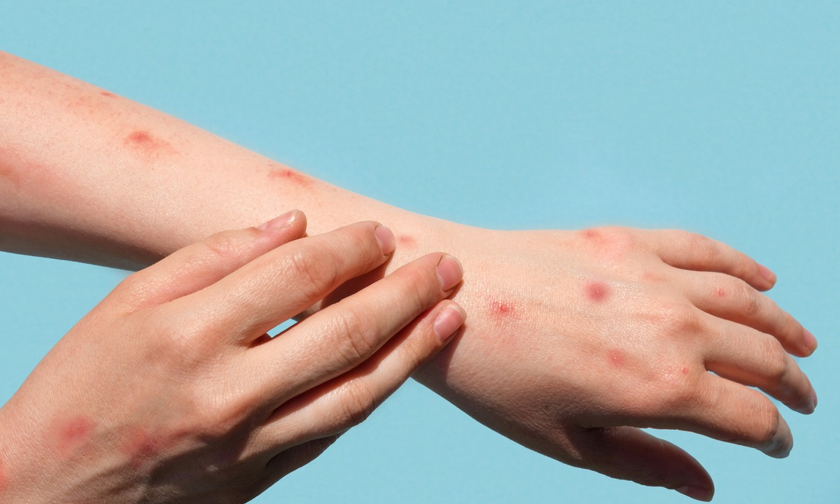 OMS recomenda chamar varíola dos macacos de  mpox para evitar linguagem racista