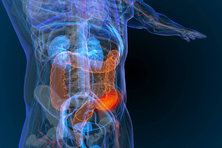Instituto conclui que mortes precoces por câncer de intestino devem crescer 10% até 2030 no Brasil