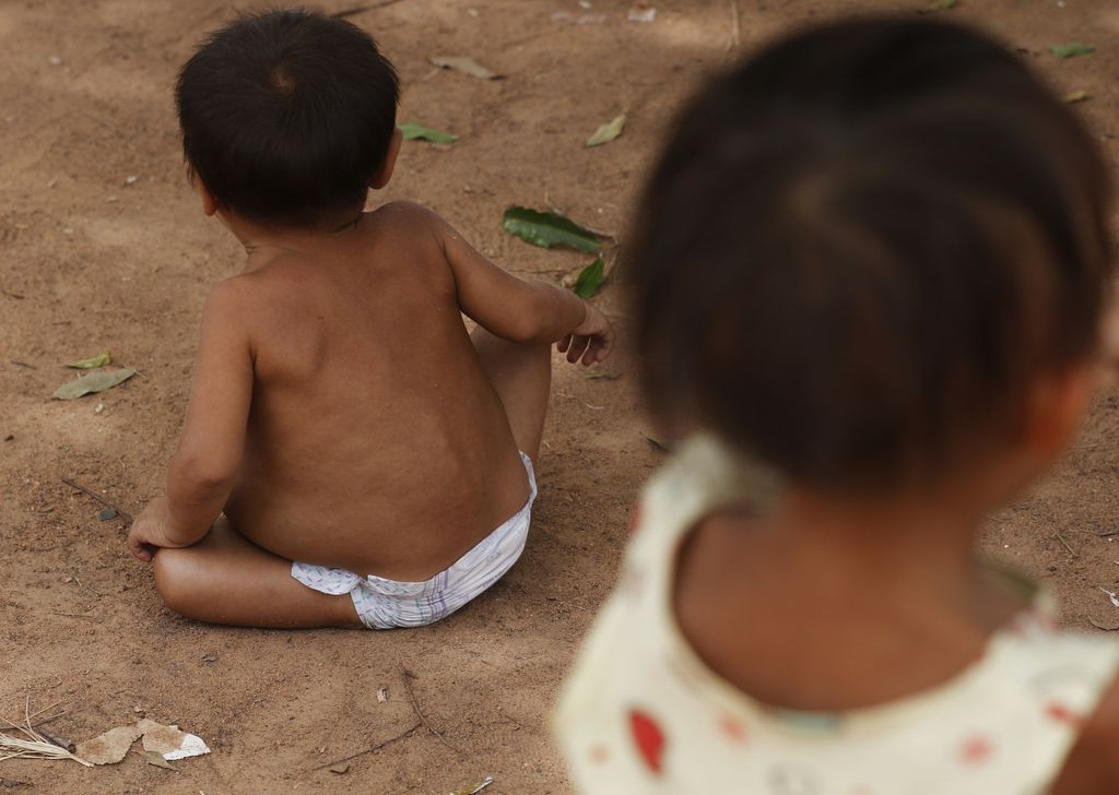 Mais da metade das crianças Yanomami resgatadas com desnutrição grave apresenta melhora