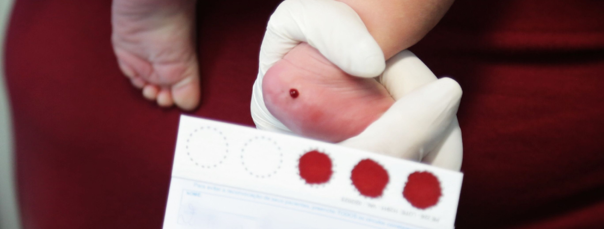 Teste do pezinho ajuda no diagnóstico precoce de doenças raras