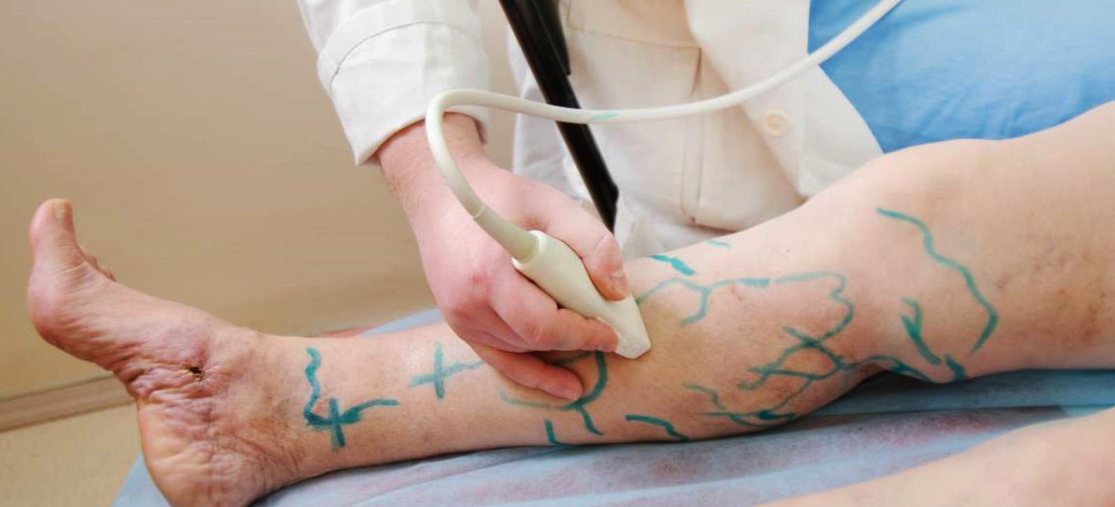 Dados mostram que 145 mulheres são internadas para tratar varizes no País