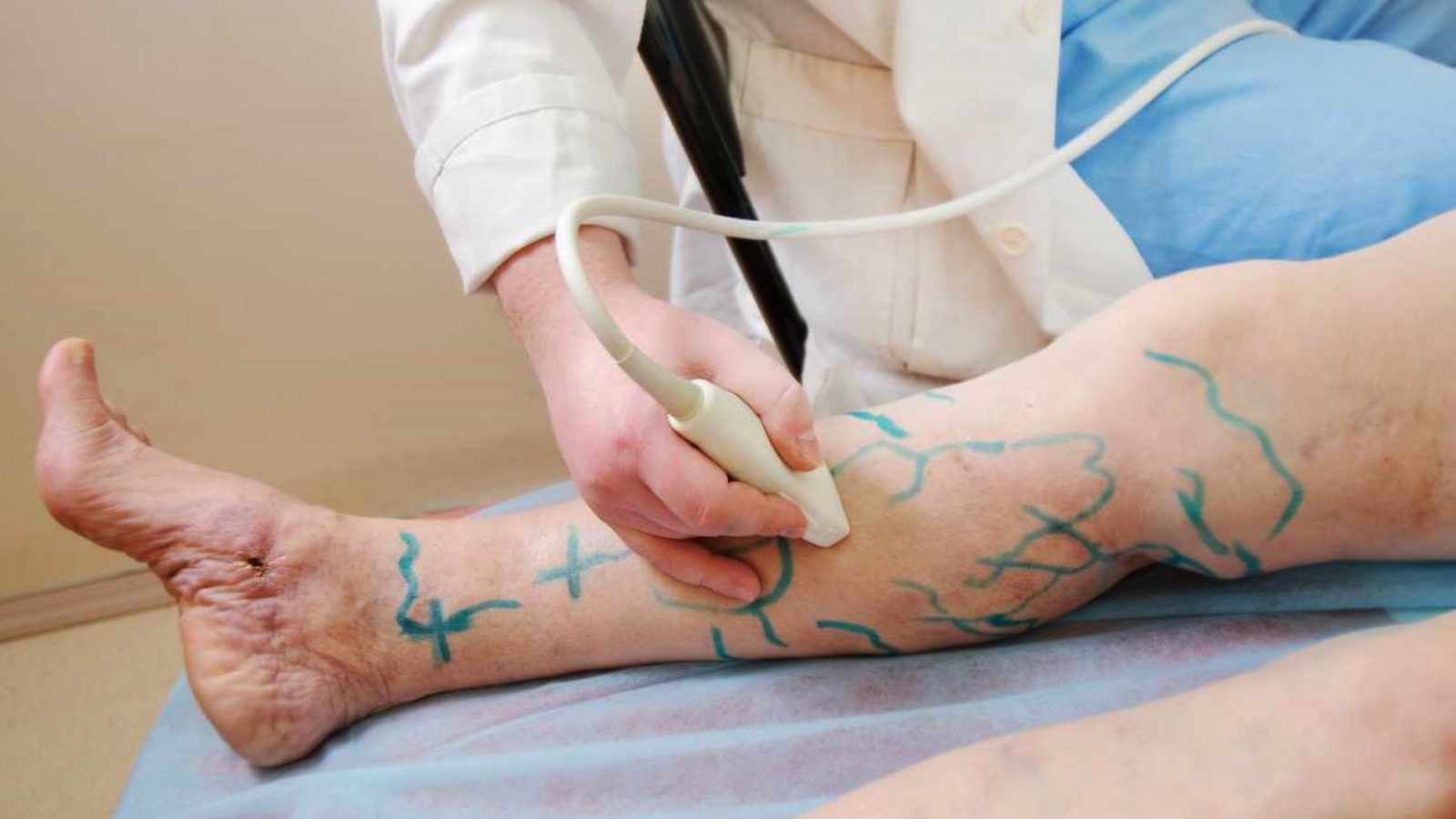 Dados mostram que 145 mulheres são internadas para tratar varizes no País