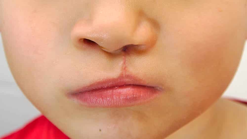 PL da Aleam quer rastrear nascimento de crianças com fissura labiopalatal para agilizar tratamento