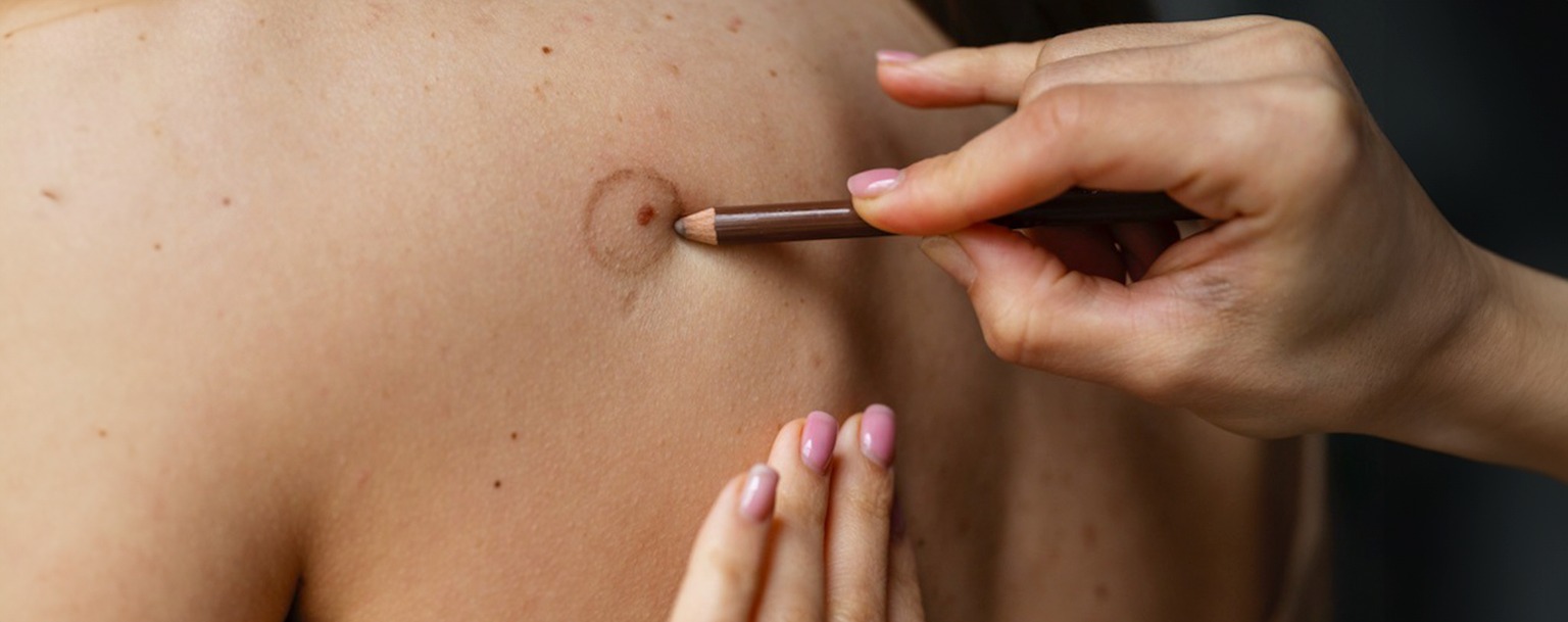 Melanoma: veja sinais de alerta do câncer de pele mais agressivo