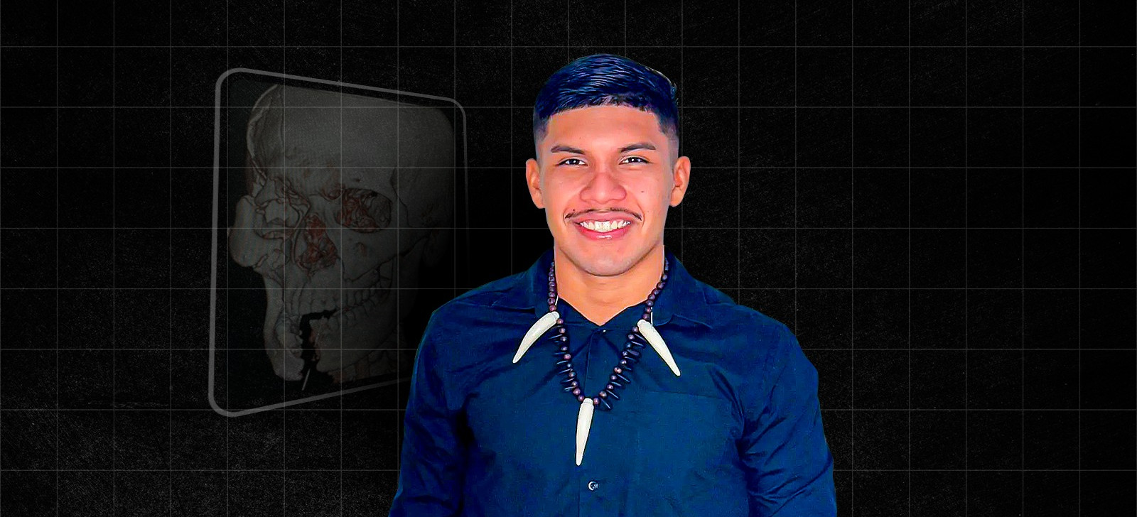 Indígena aguarda há 22 dias por cirurgia após grave acidente no AM