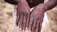 Primeiro caso de nova cepa de mpox é confirmado no Brasil