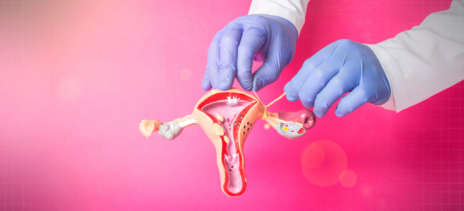 Julgamento no STF sobre laqueadura e vasectomia é adiado