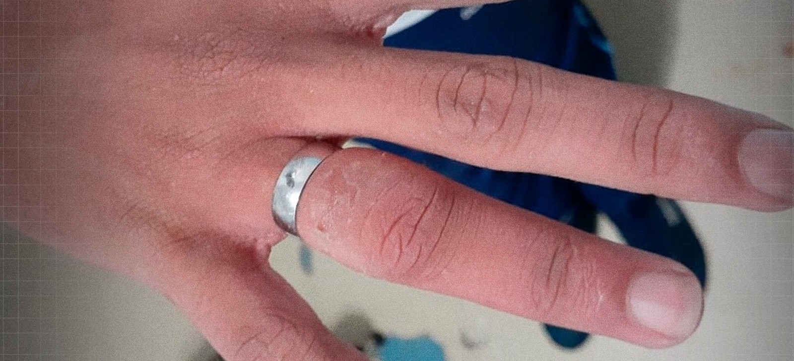 Em Manaus, mais de 400 pessoas são socorridas por ano com anéis presos aos dedos