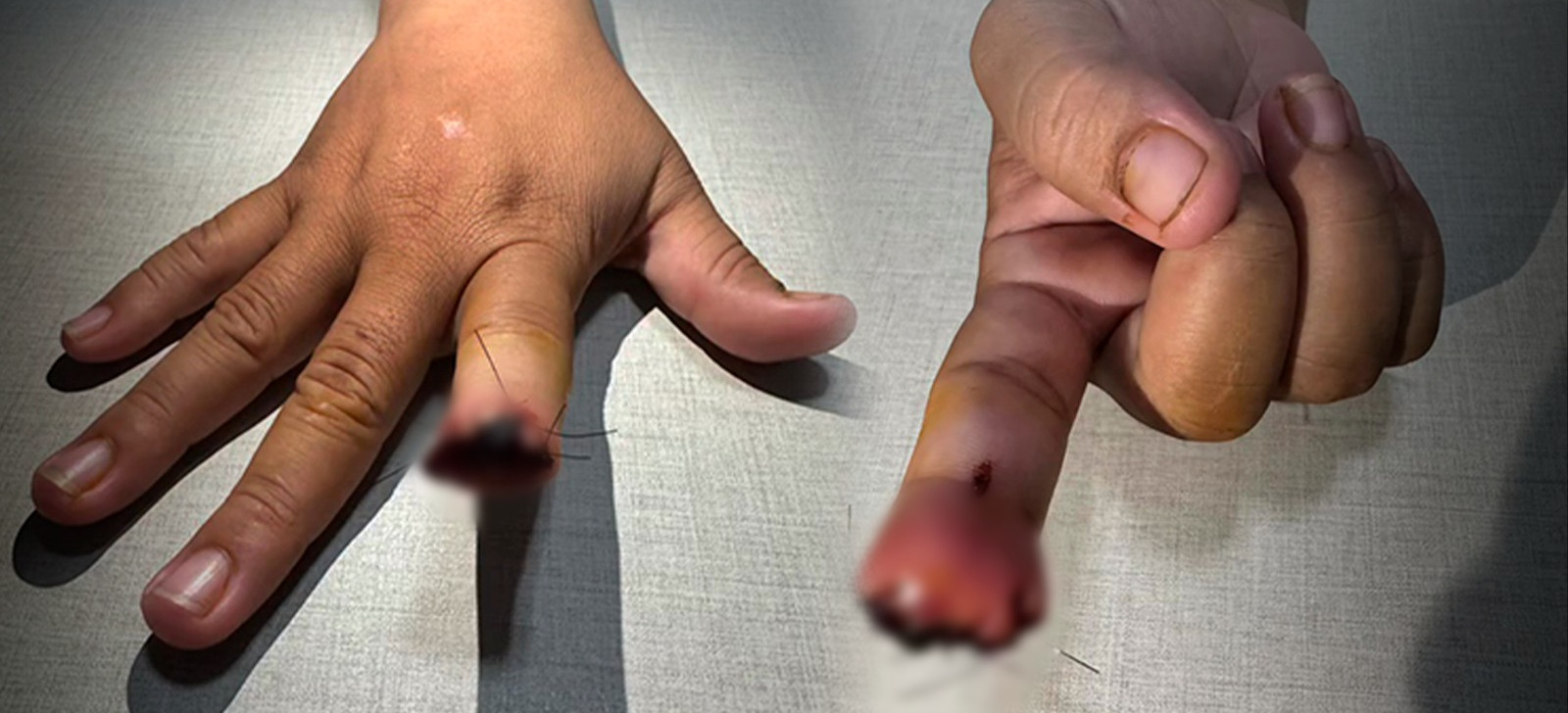 PC pede prisão de suspeito de arrancar dedo da companheira em Manaus