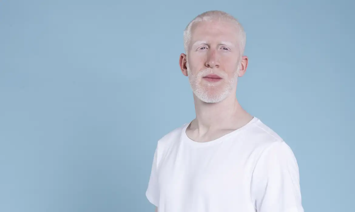 Pessoas com albinismo agora têm política de proteção garantida