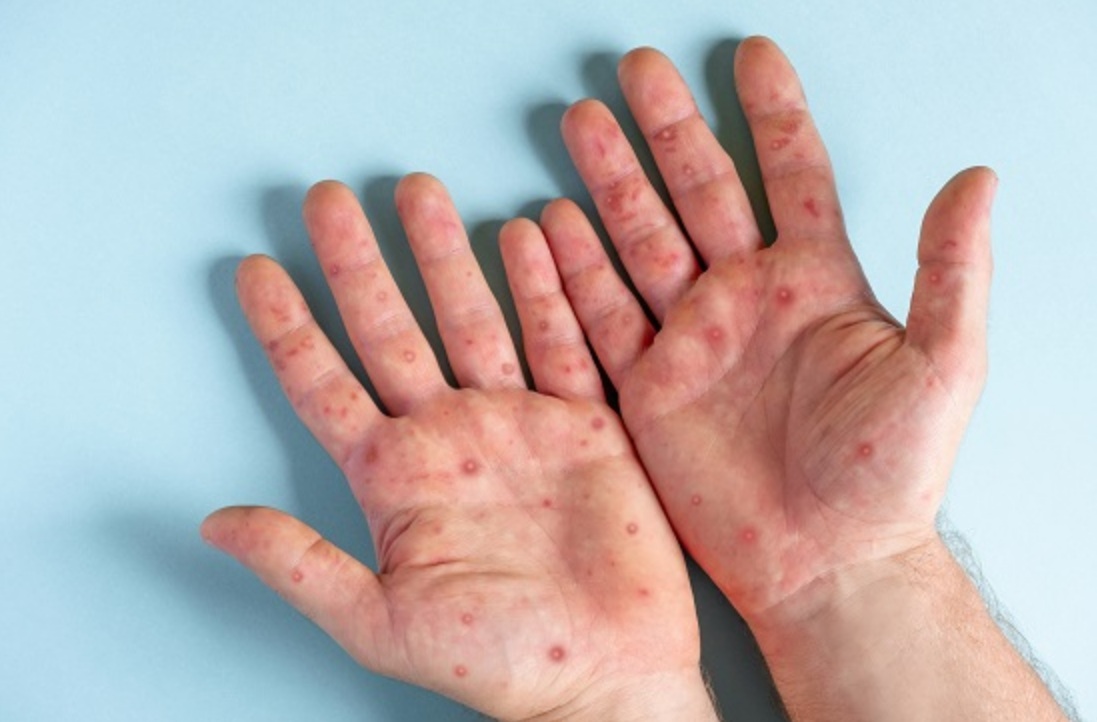 Estados da Região Norte registram casos de Mpox e descartam surto