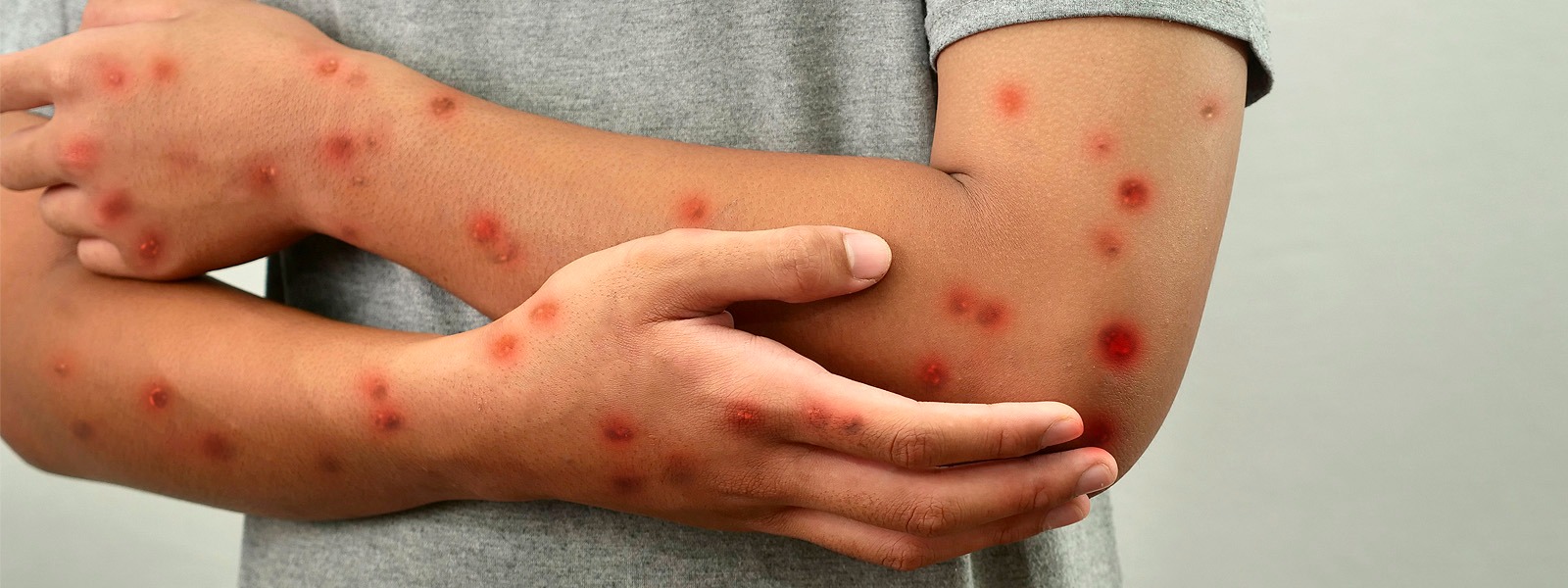 Mpox: Specialist warns that despite low lethality, the disease requires attention