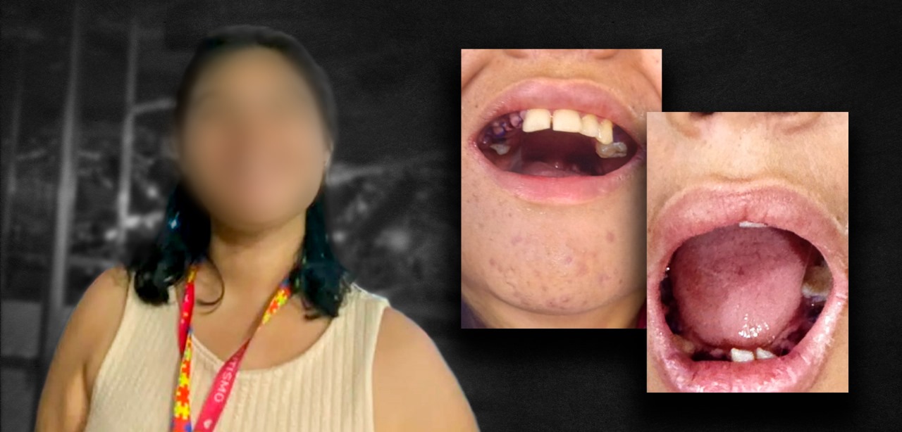 Jovem autista tem 17 dentes extraídos sem aval da família em Belém