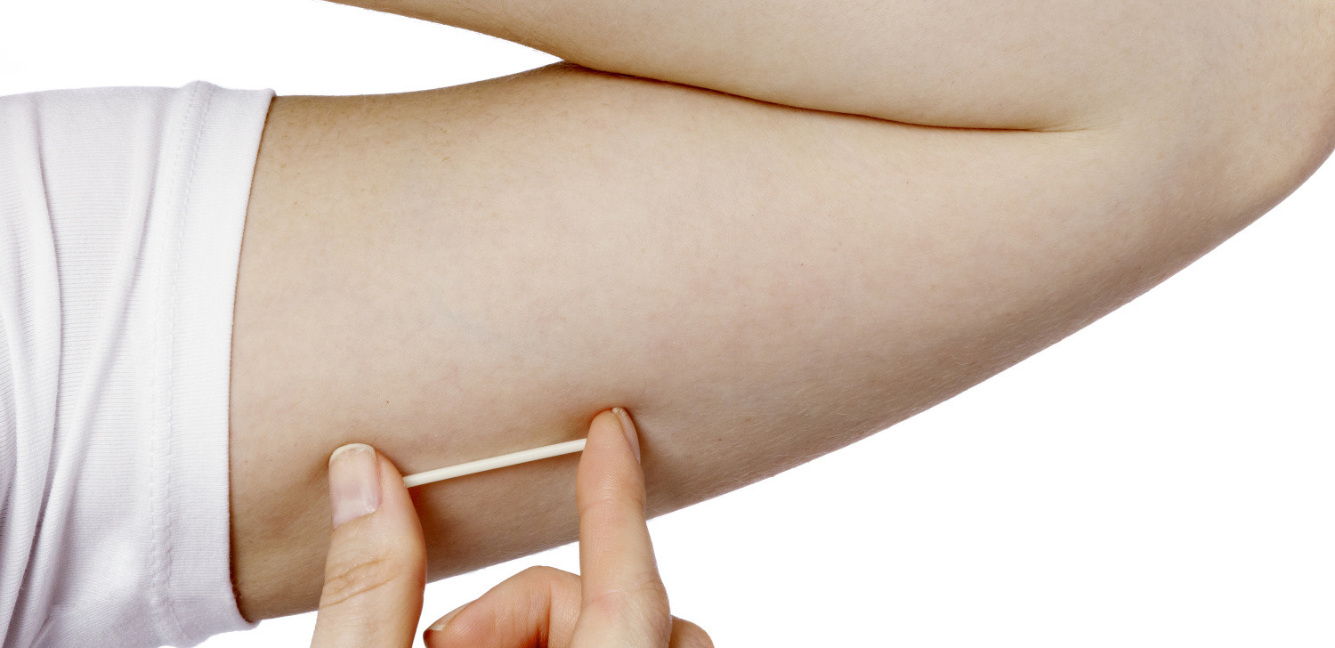 Implante hormonal entra no rol de procedimentos obrigatórios da ANS